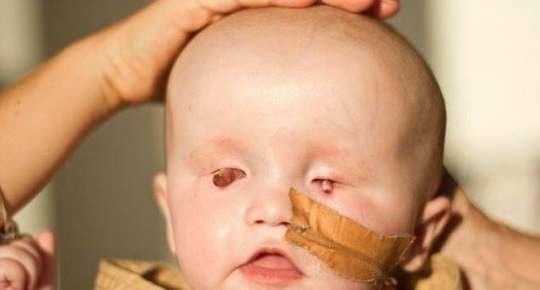 Uşaq gözsüz doğuldu - Görə bilməsi üçün həkimlər çarə axtarır