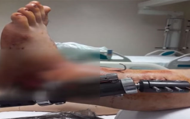 Bir həkim ayağını kəsdi, digəri yerinə tikdi - Video