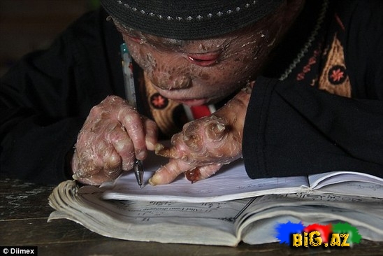 İnanılmaz xəstəlik: 41 gündən bir dərisini dəyişir - FOTO