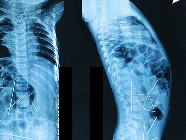 11 aylıq uşağın bədənində 16 iynə tapıldı - VİDEO