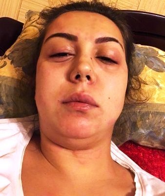 Ağır xəstəlikdən əziyyət çəkən tanınmış müğənnimiz tanınmaz halda - ÜRƏKDAĞLAYAN FOTO