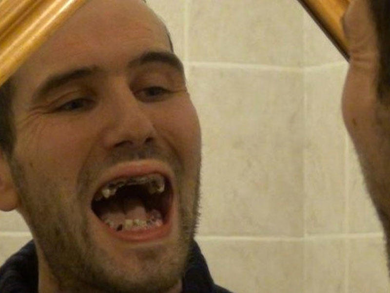 Hər gün qazlı su içən kişinin dişləri bu hala düşdü - FOTO