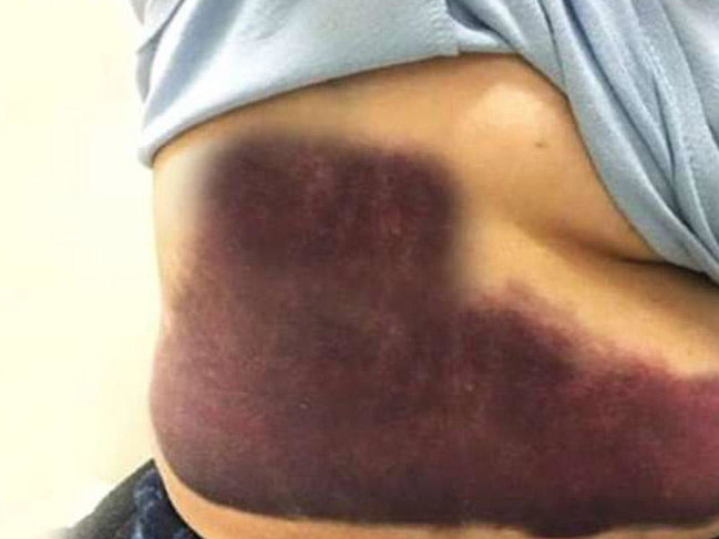 Qrip oldu, qabırğaları sındı - VİDEO