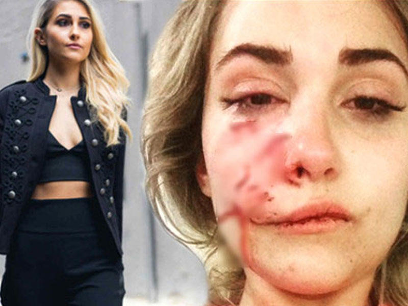 İt tanınmış modelin üzünü parçaladı - Üst dodağı tərpənmir - VİDEO - FOTO
