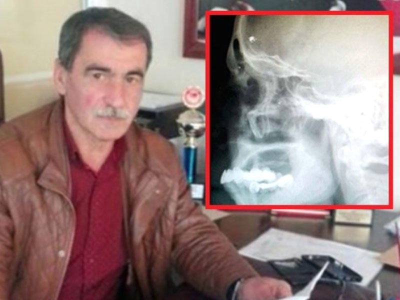 Başı ağrıyan kişini rentgenə saldılar: Həqiqəti görən həkim ŞOK OLDU - VİDEO