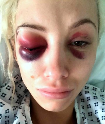 Əsir götürülüb zorlanan modelin bir gözü kor oldu (+18 FOTO)