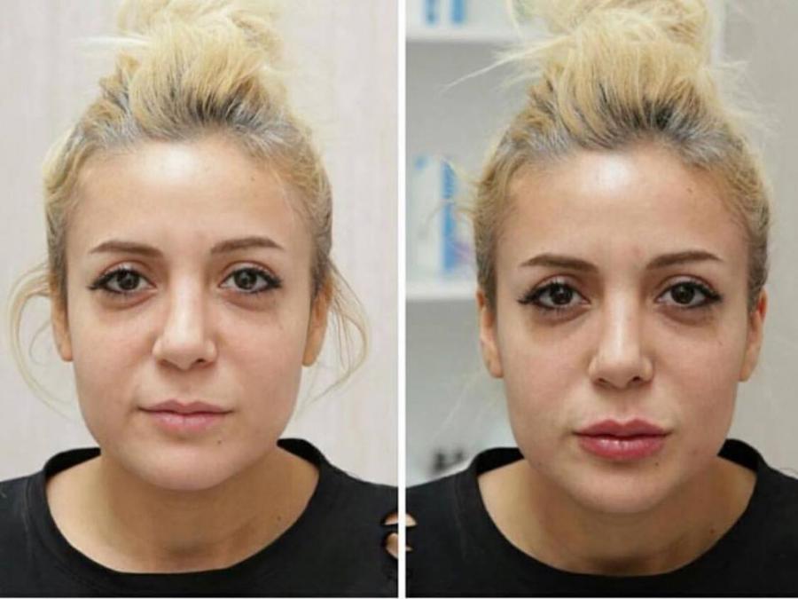 Səidə dodaqlarını böyütdürdü