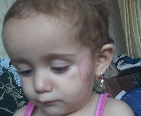 Bağçada körpənin xəsarət almasına görə iki nəfər işdən çıxarılıb