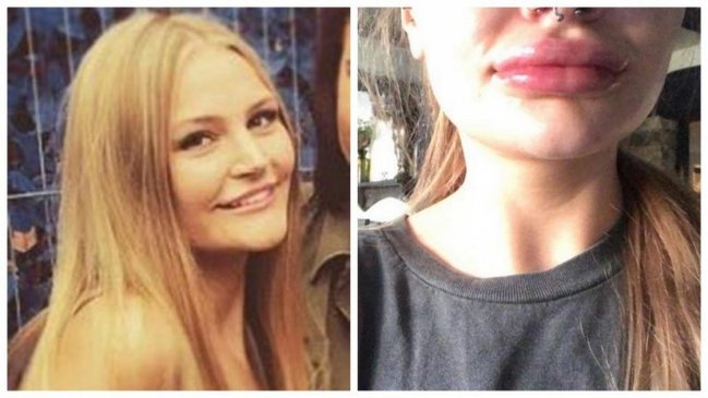 Vurdurduğu iynəyə görə dodaqları eybəcər hala düşdü, həkimlərin cavabı isə şok etdi - Video