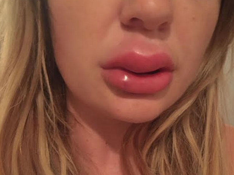 Dodağını şişirdən qadın: 