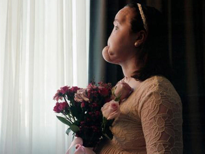 Dünyada ilk dəfə: üzünü məhv etmiş qızın siması bərpa olundu - VİDEO - FOTO