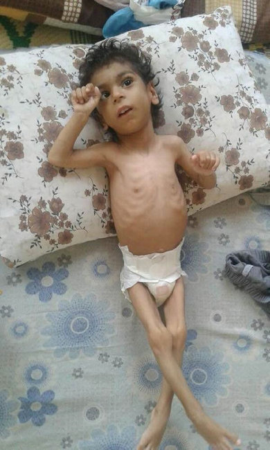 Ac qaldığına görə it-pişik əti yedi, infeksiyaya yoluxdu - Ürəkparçalayan FOTO