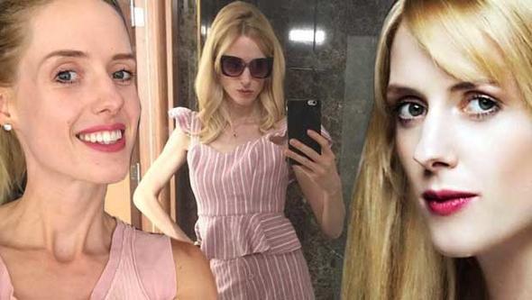 Anoreksiya xəstəsi olduğu deyilən aktrisadan bikinili poz - Fotolar