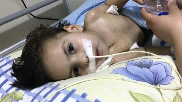 Bütöv fındıq udan uşaq infarkt keçirdi: nə danışa bilir, nə gəzə - FOTO