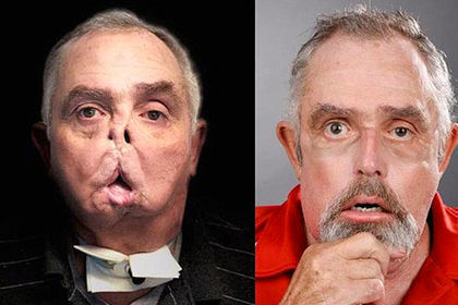 Yaşlı ovçuya yeni üz nəqli baş tutdu