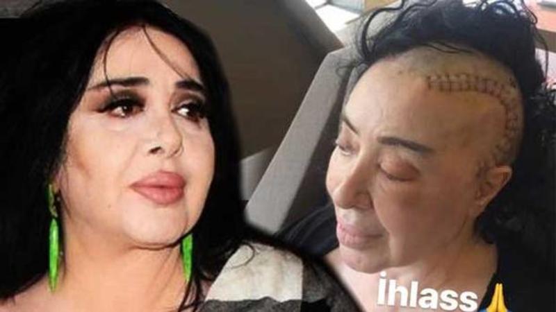 Beyin əməliyyatı keçirən məşhur modelyer tikiş izini paylaşdı - FOTO