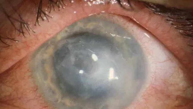 Linza istifadəçilərinə XƏBƏRDARLIQ - TƏHLÜKƏLİ İNFEKSİYA