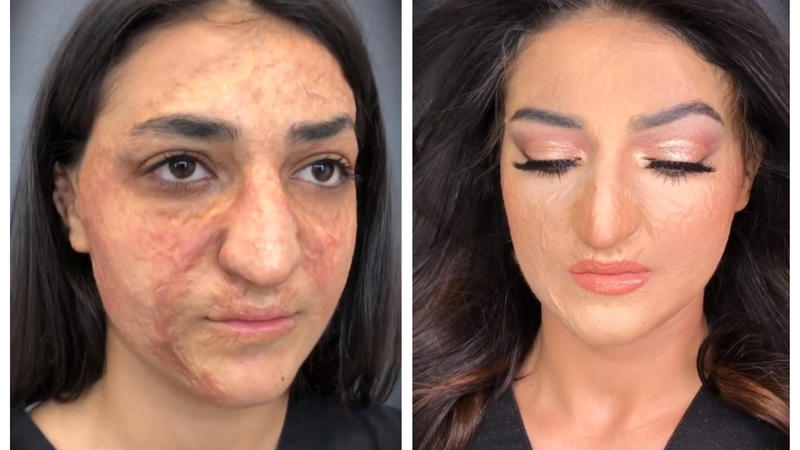 Dünyaya səs salan azərbaycanlı vizajist üzü yanmış xanımı TANINMAZ HALA SALDI - VİDEO