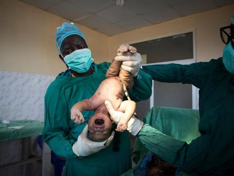 Bu ölkədə xəstələri maşın ehtiyat hissələri ilə əməliyyat edirlər - FOTO