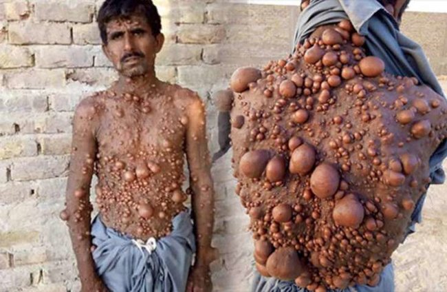 DƏHŞƏT: Xəstəliyinə görə ailəsi ondan imtina etdi - FOTOLAR