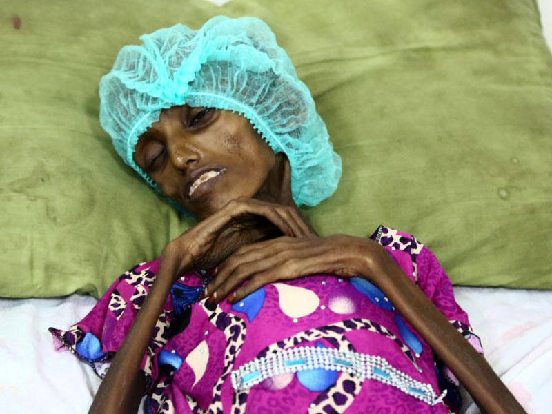 Dünyanı utandıracaq FOTO - 13 milyon insan ac qalıb