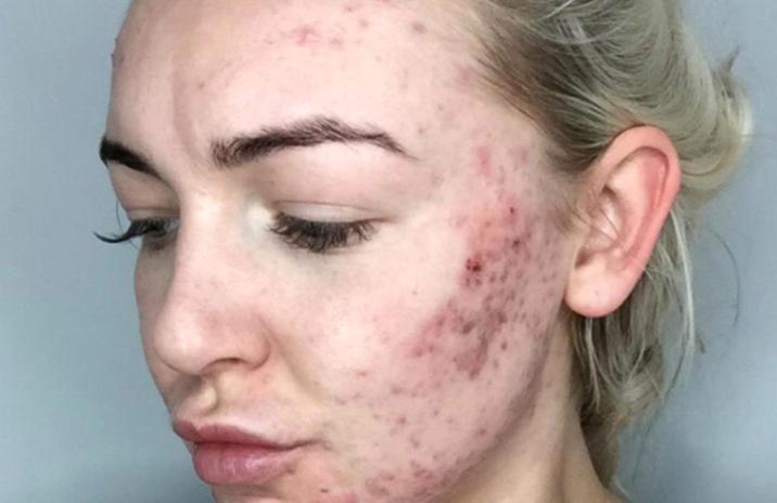 Sızanaqlara görə aynaya nifrət edən qızı indi görün... - Fotolar