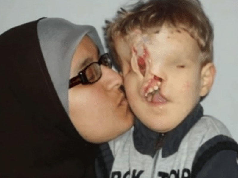 Anadangəlmə üzünün yarısı olmayan uşaq əməliyyat olundu - FOTO