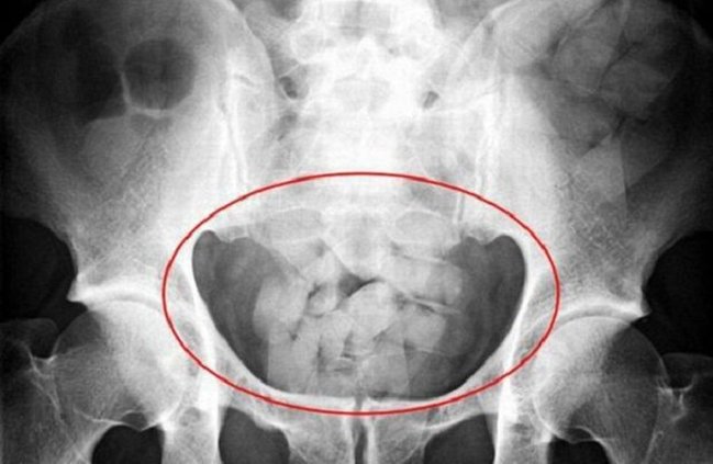 İran vətəndaşının düz bağırsağından çıxanlar hər kəsi təəccübləndirdi - FOTO