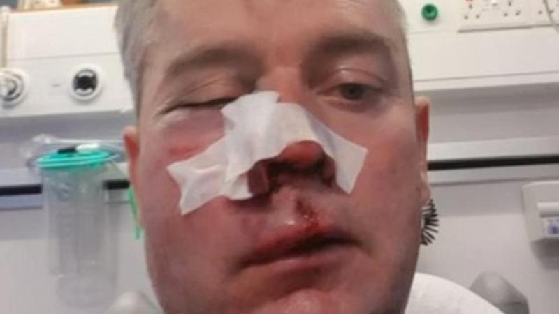 Futbolçular və azarkeşlər hakimin çənəsini sındırdılar