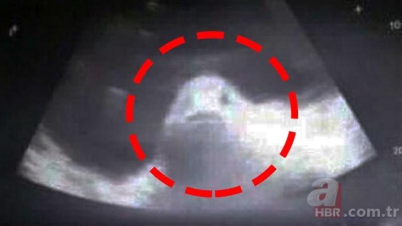 Dünyada GÖRÜNMƏMİŞ HADİSƏ: 17 yaşlı qız balıqdan HAMİLƏ QALDI - FOTOLAR