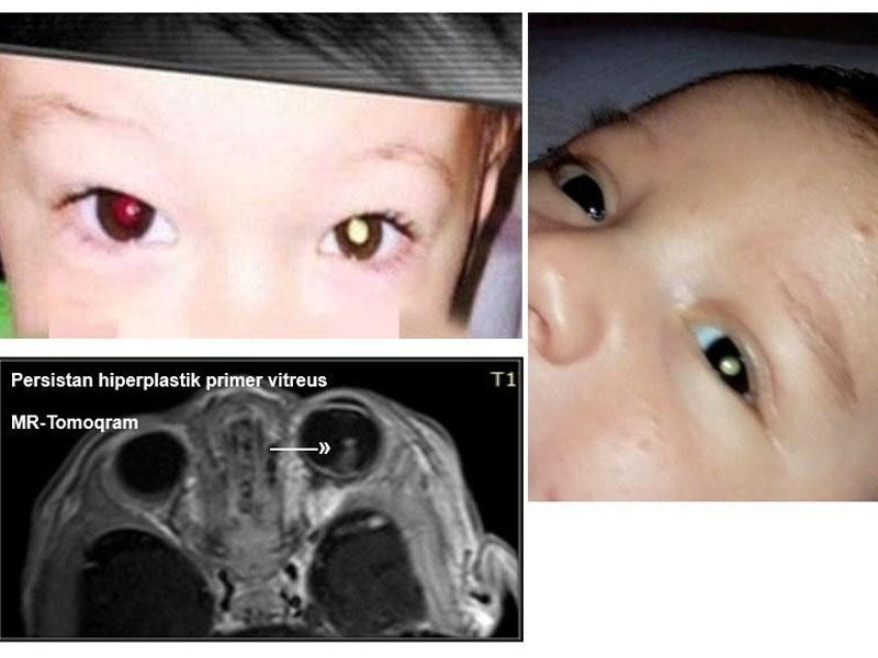 Mobil telefonla çəkdiyi şəkillə körpəsində göz xəstəliyi aşkarladı - FOTO