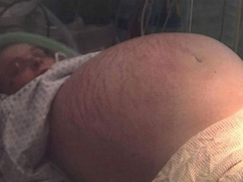 Hamilə olduğu düşünülən qadının qarnından 28 kq-lıq kist çıxarıldı - FOTO