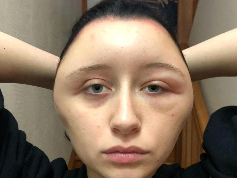 Saç boyasından düzgün istifadə etməyən qızın üzü şişdi - FOTO