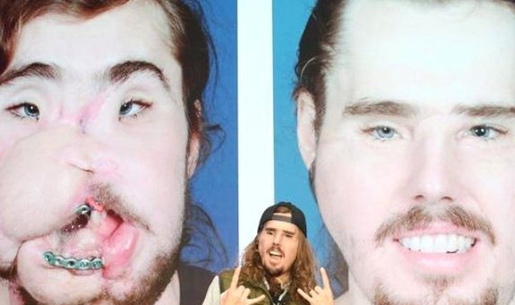 Sifətini gülləylə vurub paramparça etdi - Başqa insanın üzü ilə yenidən həyata qayıtdı - FOTOLAR