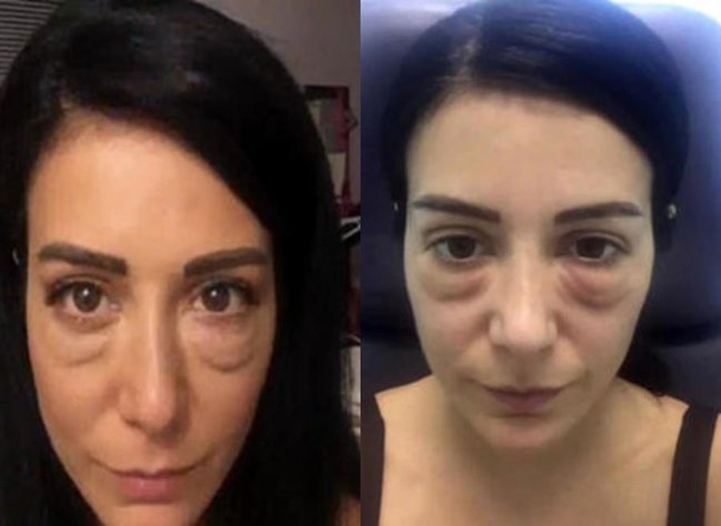 Model estetik qurbanı oldu: Üzü tanınmaz hala düşdü - FOTO