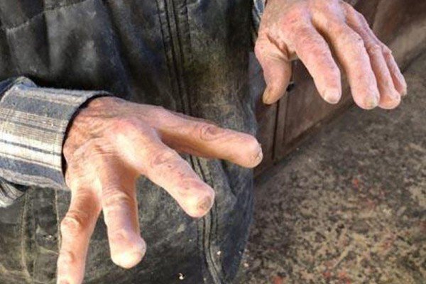 10 barmağını itirdi, sevdiyi peşəni atmadı - Onu görən hər kəs şoka düşür - FOTO