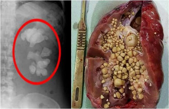 DƏHŞƏT! Böyrəyindən 172 MİN ədəd DAŞ ÇIXDI - Həkimlər inana bilmir / VİDEO