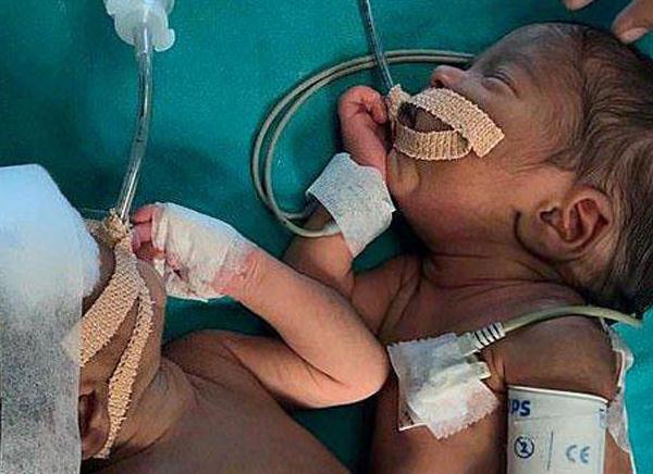 Cərrahlar 3 günlük siam əkizlərini ayıra bildilər - FOTO