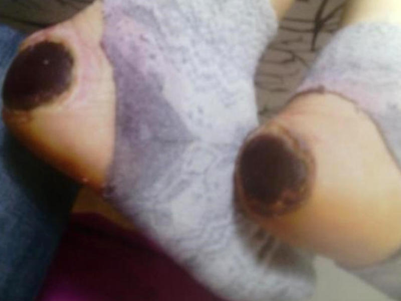 Doğum evində hamilə qadının ayağını yandırdılar - FOTO