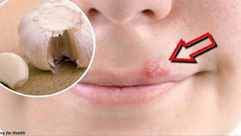 Herpes xəstəliyindən qurtulmağın ən ucuz üsulu – Xalq təbabəti