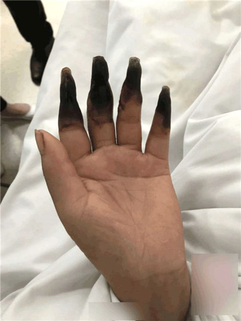 Təmizlik edən qadının barmaqları qorxunc hala düşdü - FOTOLAR