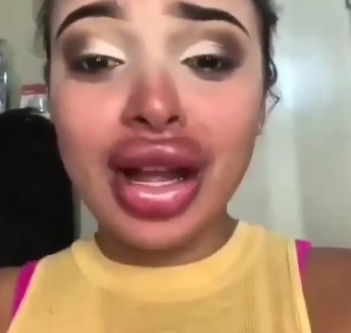 Saxta gel vurulduğu üçün dodağı tanınmaz hala dşüdü - VİDEO