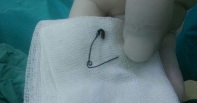 İynə udduqda orqanizmdə nə baş verir?