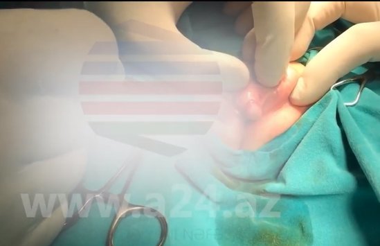 Azərbaycanda görülməmi̇ş hadi̇sə – oğlan uşağını sünnət etdi̇rmək üçün gəti̇rdi̇lər, qız çıxdı