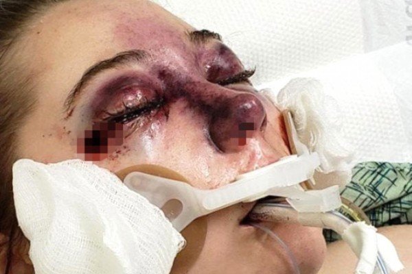 Tətildən qayıdan qız dəhşətli xəstəliyə tutuldu - FOTOLAR