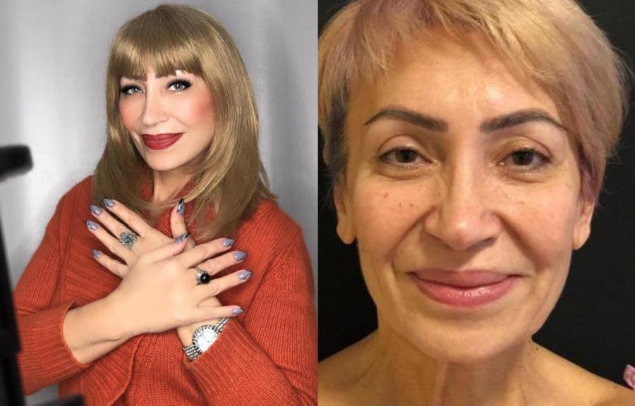 57 yaşlı Əməkdar artistin əməliyyatdan sonrakı halı - Fotolar