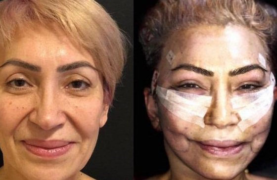 Əməkdar artist estetik əməliyyatlardan sonra ilk dəfə efirə çıxdı - BU DA FOTOLAR