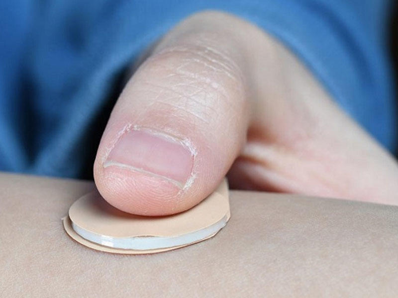 Qadınlar üçün hamiləlik əleyhinə yeni mikroplastır icad olundu - 1 ay qoruya biləcək