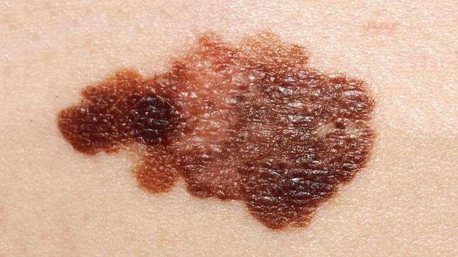 Dərisindəki xərçəngi kəsib atdı - Elə bir şey baş verdi ki.../ VİDEO