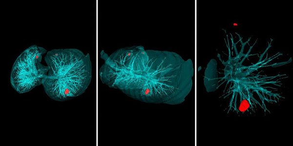 Xərçəngi 20 saniyədə müəyyənləşdirməyin yolu tapıldı